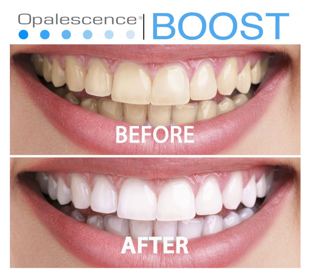 Opalescence Boost